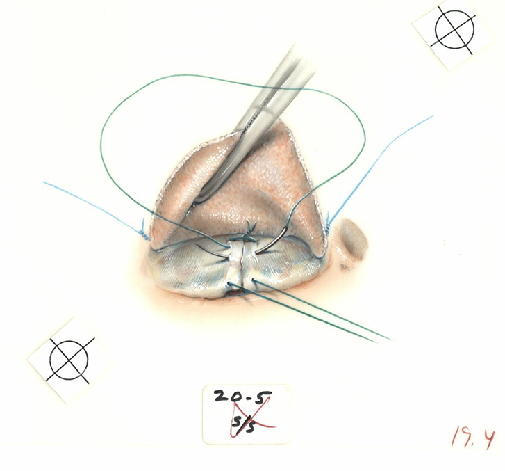 Color illustration of bicuspid repair of the anterior and posterior leaflets.