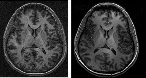 MRI Image Quality Compared at 3T and 3T
