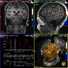 an example of brain activation of the auditory 7T fMRI study (click to enlarge)