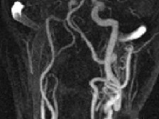 Neuwelt: Ferumoxytol CE MR Angiography of the supra-aortic arteries (click to enlarge)