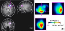 Rooney: MS lesion measured by post-contrast T1-weighted MRI data set (click to enlarge)