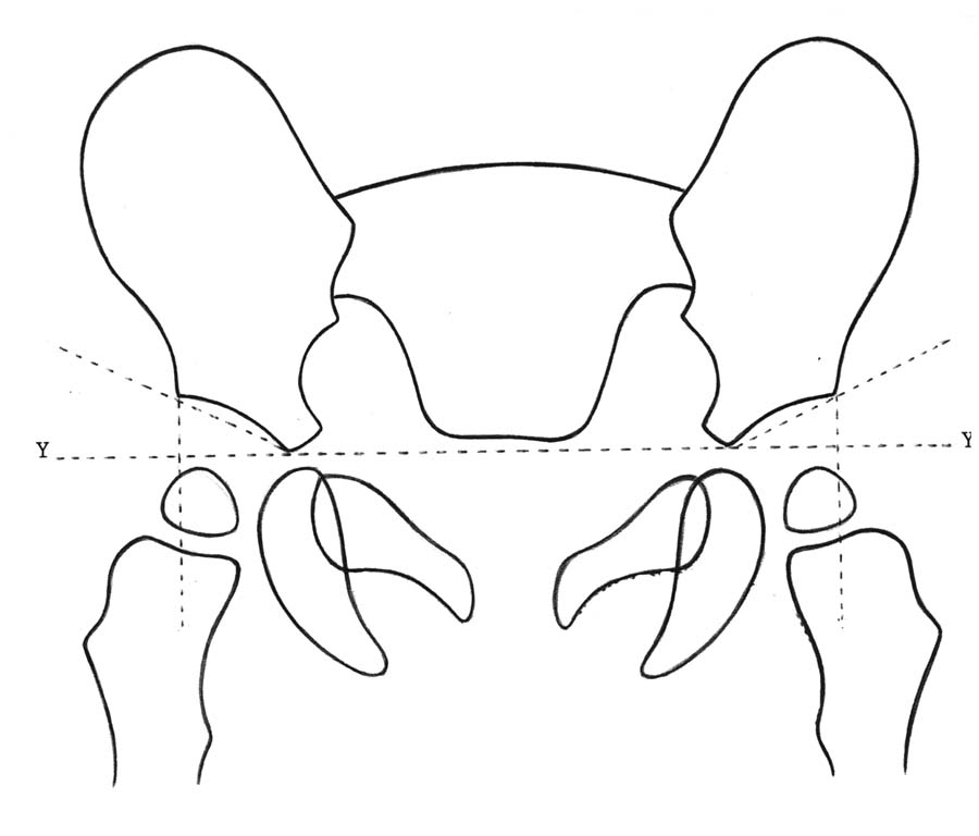 DRAD Pediatric Normal Measurements AP Pelvis Radiograph Acetabular Angle