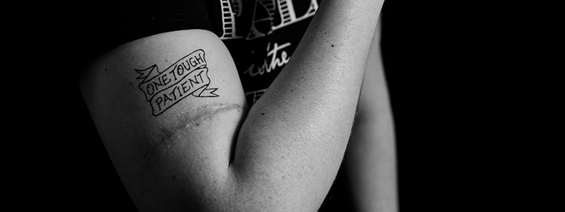 A melanoma survivor and her scar.