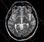 MRI Brain Image