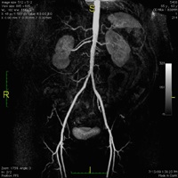 Renal and Iliac arteries