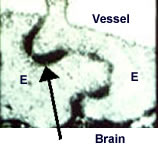 After blood-brain-barrier disruption, the blood-brain barrier is permeable, as shown by this electron micrograph of the stained peroxidase enzymes between endothelial cells