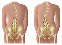 Types of scoliosis