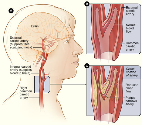 Illustration of carotid endarterectomy