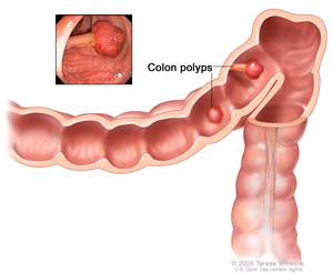 This illustration shows a section of colon that stretches across the frame before turning down at a right angle. A cross-sectional view shows two polyps growing on the colon’s inside surface. The polyps are red, about the size of peas, and have stems that connect to the colon.