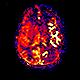 Arterial Spin Labeling MRI Perfusion image A for Radiology