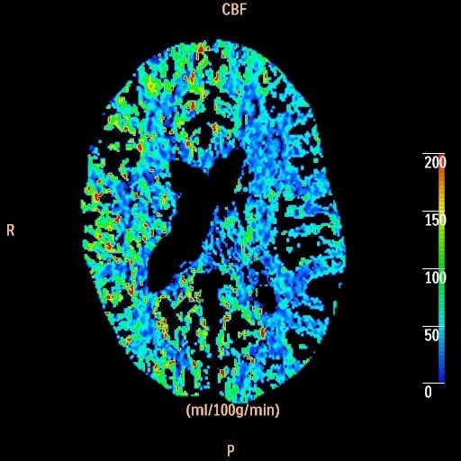 CT Perfusion scan for Radiology