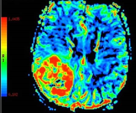 Dynamic Susceptibility Contrast MRI Perfusion image A for Radiology