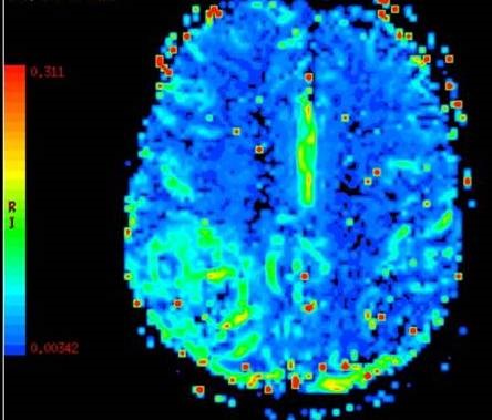 Dynamic Susceptibility Contrast MRI Perfusion image B for Radiology