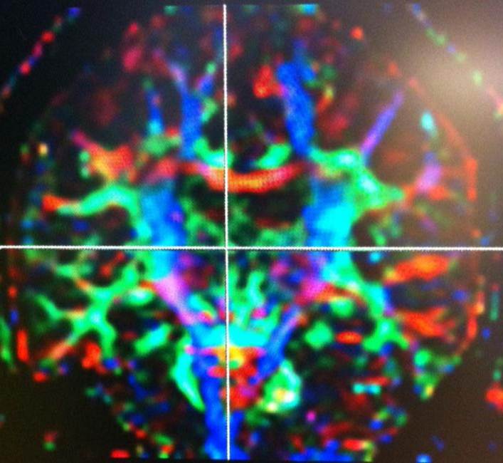 Diagnostic Radiology Neuroradiology DTI Image C