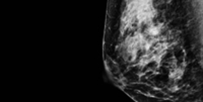 Heterogeneous Mammogram for Radiology