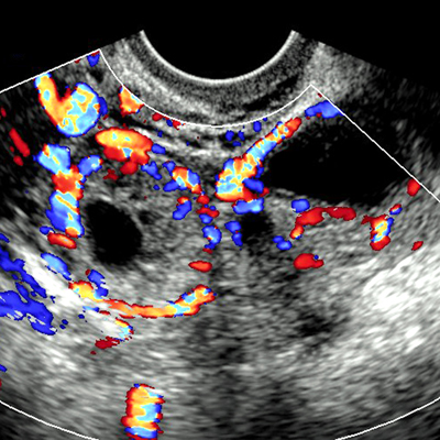 Ectopic Ureter for Radiology