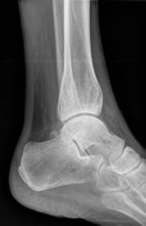 MSK Heel Image for radiology