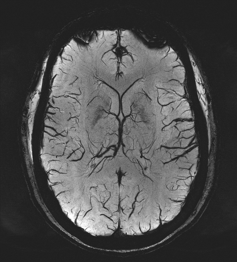 Susceptibility Weighted Image for Radiology