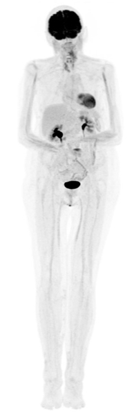 Nuclear Medicine Whole body scan- Radiology