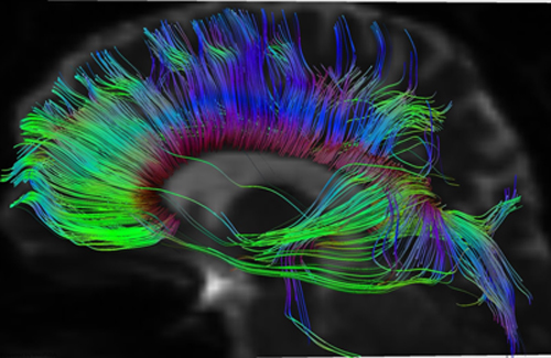Diffusion Tensor Tractography MRI Image for Radiology