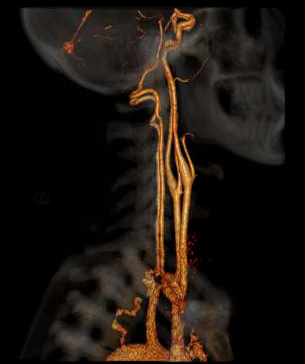 CTA of the Head and Neck image B for Radiology