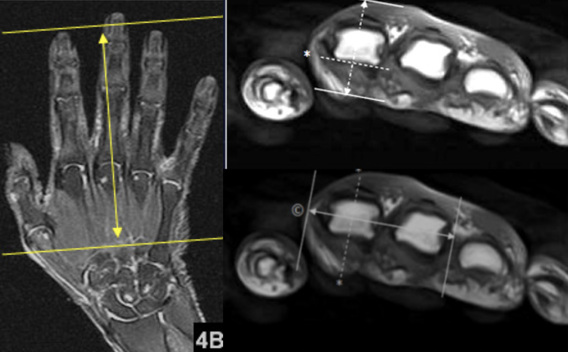MR Hand Rheumatology