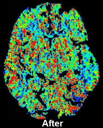 CT Perfusion with Diamox scan for Radiology- After