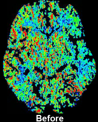 CT Perfusion with Diamox scan for Radiology- Before
