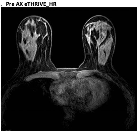 MR Breast PRE AX eTHRIVE FS