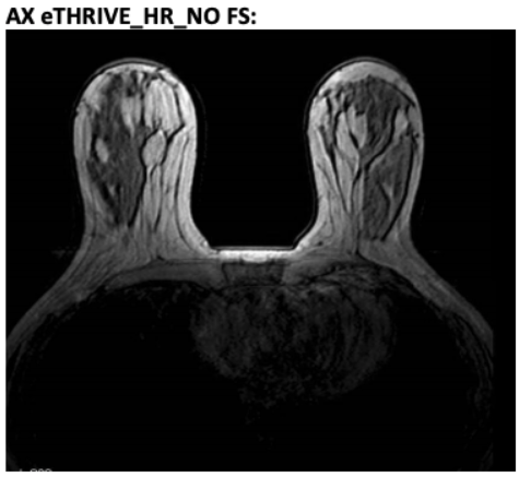 MR Breast AX eTHRIVE NO FS