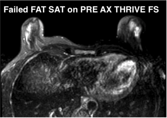 MR Breast Pre AX eTHRIVE FS - example of failed FS