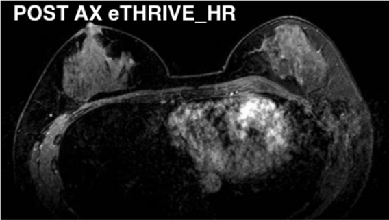 MR Breast Post AX eTHRIVE FS