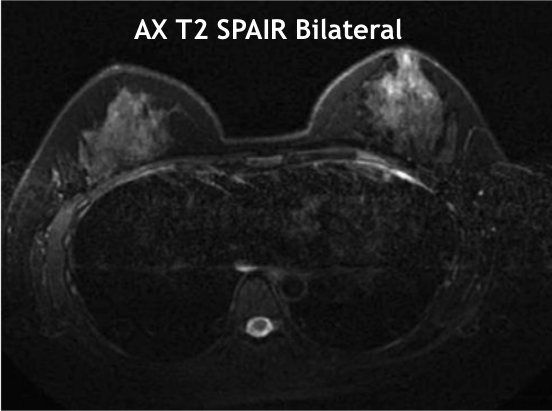 MR Breast AX T2 SPAIR