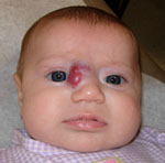 CC Hemangioma Pre Op