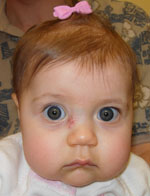 CC Hemangioma Post OP