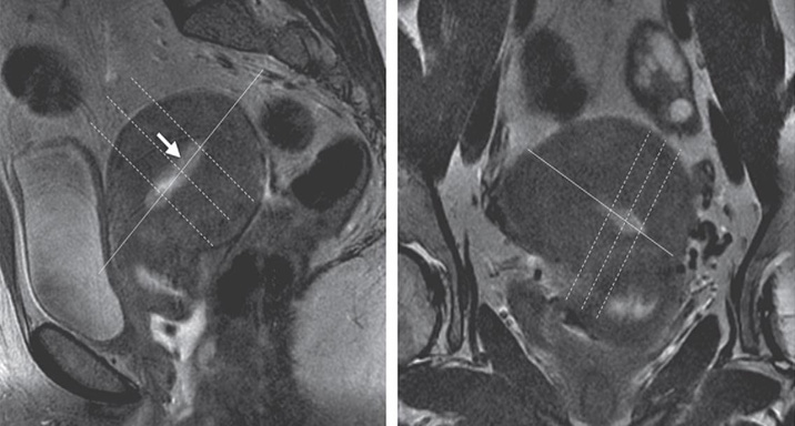 MR Adult Female Pelvis for Uterine Cancer Staging WWO BODY Protocol image 1