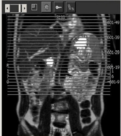 MR Adult Liver Mass WWO BODY Protocol image