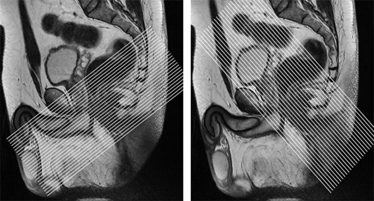 MR Adult Perineal Fistula WWO Protocol image
