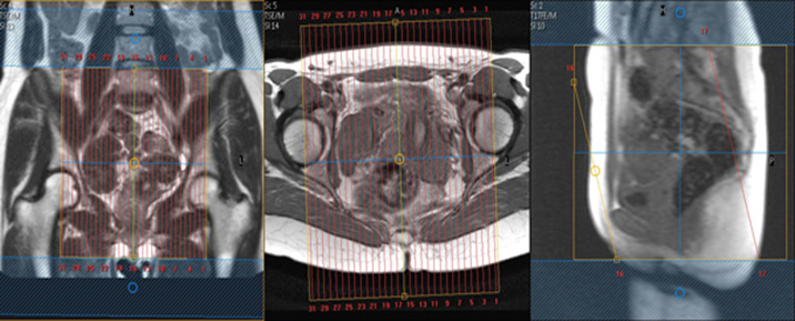 MR female Pelvis Protocol image