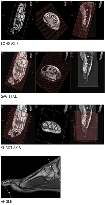 MR Foot - Forefoot WO or WWO MSK Protocol image 1