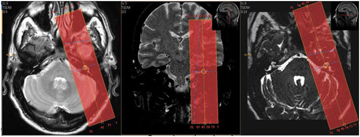 MR IAC Pre Cochlear Implant WO ENT Protocol image