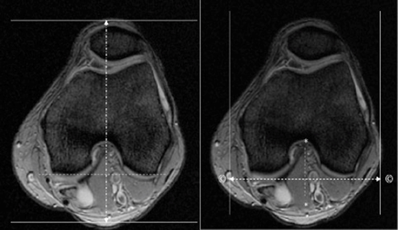 MR Knee WWO MSK Protocol image 3