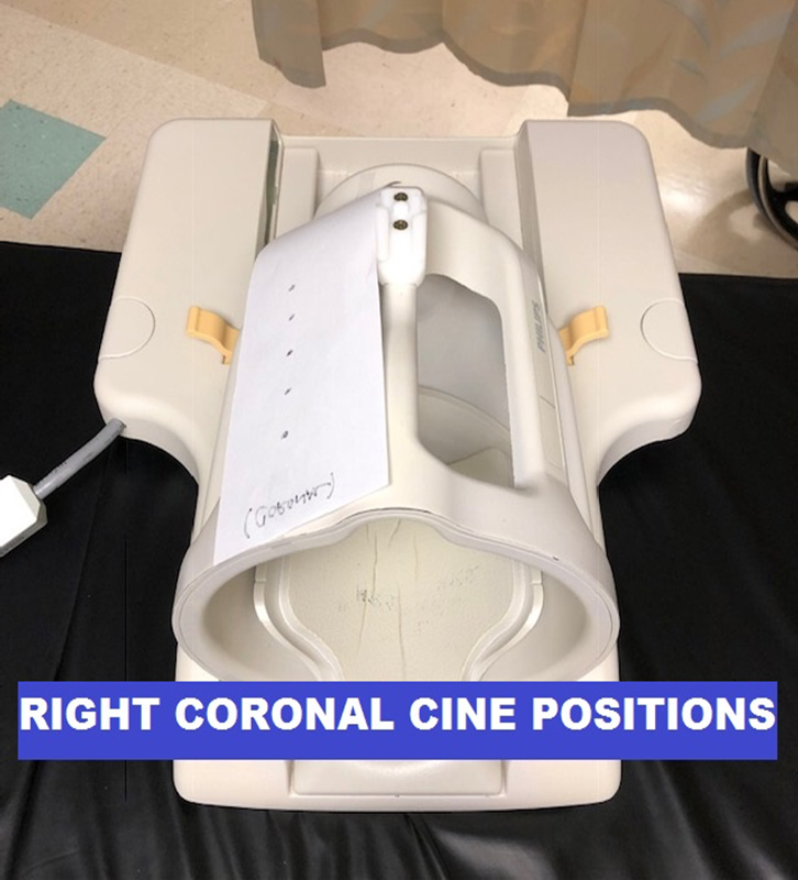 MR Orbits WO with Cine ENT Protocol right coronal cine position image