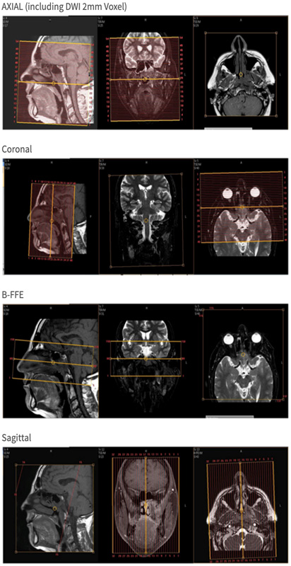 MR Parotid, Face, Sinus or Skull Base WO ENT Protocol image