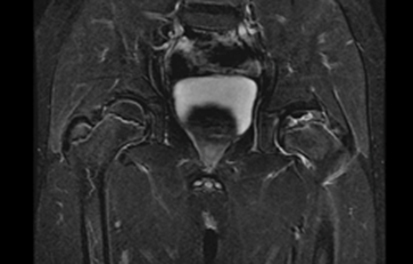 MR Pediatric Hip Perthes WWO Protocol image 1