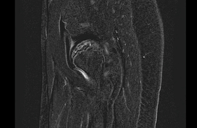 MR Pediatric Hip Perthes WWO Protocol image 2