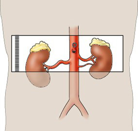 MR Renal Arterial Sclerosis Protocol - Scanning for 3D BTFE