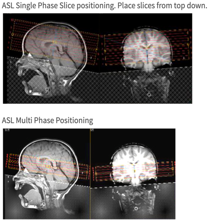MR Stroke Brain WO Neuro Radiology Protocol image 2