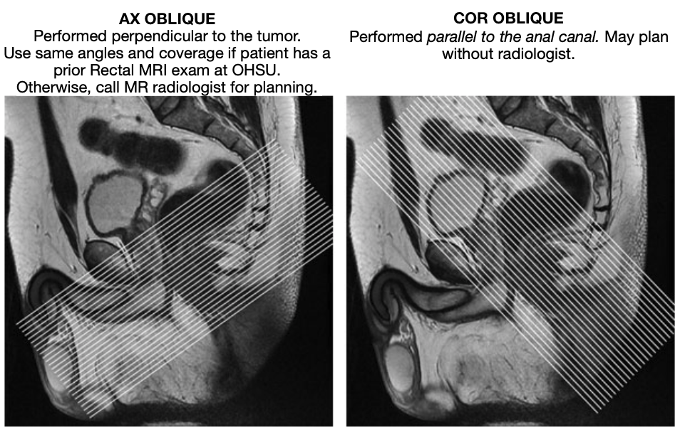 MR Adult Rectum/Rectal CA WWO Protocol Image