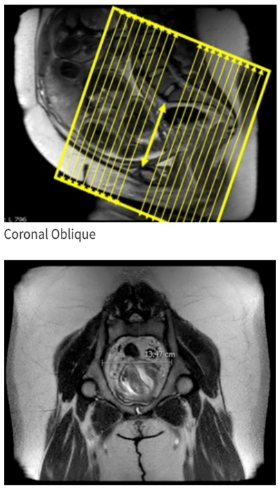 MRI Pelvimetry WO BODY Protocol image